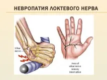 Периферична невропатія, ідіопатична та вегетативна, симптоми симптоми