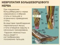Периферична невропатія, ідіопатична та вегетативна, симптоми симптоми