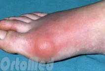 подагра