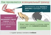 Чому виникає тремор рук у дорослих, основні причини та лікування препаратами. дорослих