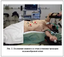 Підковоподібна нирка - причини освіти, симптоми та лікування нирка