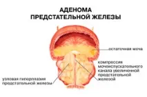 Препарати для лікування аденоми простати аденоми