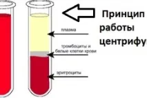 Застосування плазмаферезу для лікування ревматоїдного артриту - Експерти в області артриту