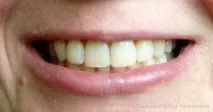 Стоматологічний мус для зубів GC Tooth Mousse - найкращий друг для красивих зубів та посмішки відгуки стоматологічний