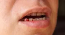 Рак ясна симптоми, перші ознаки, діагностика, методи лікування симптоми