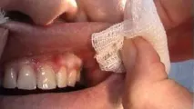 Рак ясна симптоми, перші ознаки, діагностика, методи лікування ясна