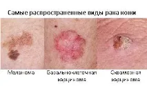 Рак шкіри носа симптоми та лікування, фото та початкова стадія лікування