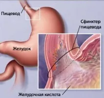 Сучасні аспекти лікування ГЕРХ лікування