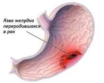 палої