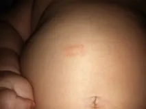 Стригучий лишай у дитини - фото симптомів, лікування та профілактика лишаю лікування