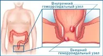 Свічки від геморою Київ, Печерськ, МедЦентрСервіс київ