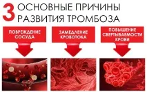 Тромбоз бути чи не бути Захистимо судини правильно бути