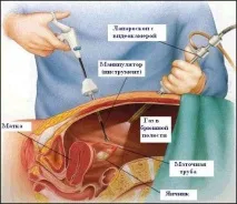 лапароскопска