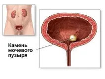 Узі малого таза у чоловіків як роблять (підготовка, що показує) чоловіків