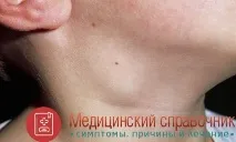 Запалення лімфовузлів на шиї, в паху - симптоми, причини, лікування паху