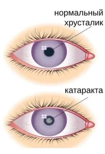 Вікова катаракта - Центр очної хірургії катаракта
