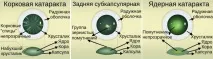 Вікова катаракта - Центр очної хірургії центр