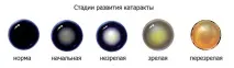 Вікова катаракта - Центр очної хірургії центр