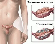 Яєчникова аменорея полікістозних яєчників