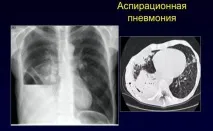 Аспіраційна пневмонія - причини та лікування причини