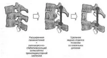 Стеноз та звуження хребетного каналу - лікування та профілактика стеноз