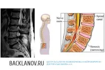 Стеноз та звуження хребетного каналу - лікування та профілактика каналу