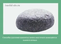 Способи видалення каменів з нирок або з’являються камені в нирках - Блог про здоров’я каменів