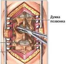 Стеноз та звуження хребетного каналу - лікування та профілактика звуження