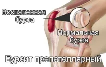 Що таке бурсит колінного суглоба симптоми та лікування запалення медикаментами та мазями колінного