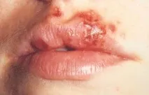 Що таке герпес і як його лікувати таке