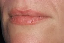 Що таке герпес і як його лікувати таке