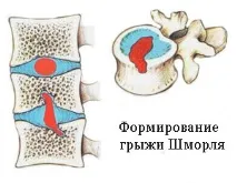 Що таке грижа Шморля хребта шморля