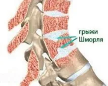 Що таке грижа Шморля хребта шморля