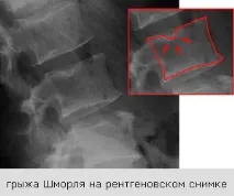 Що таке грижа Шморля хребта таке