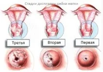Дисплазія шийки матки та вагітність сумісність матки