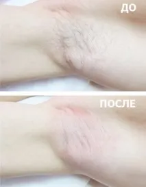 епіляція
