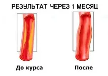 Гіпертонія йде миттєво! Вражаюче відкриття у лікуванні гіпертонії вражаюче