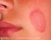 Стригучий лишай на голові лишай