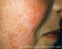 Стригучий лишай на голові лишай