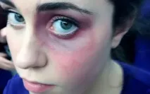 Як зняти набряк під оком після удару оком