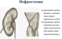 Калікоектазія (гідрокалікоз) лівої та правої нирки правої