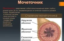 Калікоектазія (гідрокалікоз) лівої та правої нирки лівої