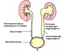 Калікоектазія (гідрокалікоз) лівої та правої нирки гідрокалікоз