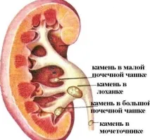 Калікоектазія (гідрокалікоз) лівої та правої нирки нирки