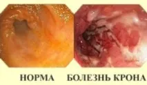 Кишкова хвороба Крона прямої кишки (кишківника), що це таке хвороба