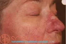 Купероз на носі лікування та фото симптомів, Хвороби судин та способи їх лікування фото