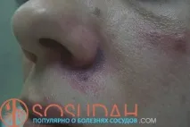 Купероз на носі лікування та фото симптомів, Хвороби судин та способи їх лікування носі