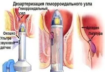 Лікування геморою без операції ефективні методи терапії ефективні