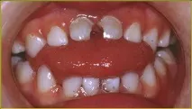 macroglossia