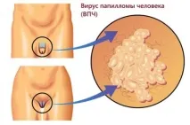 Нарости, бородавки на статевих губах. губах